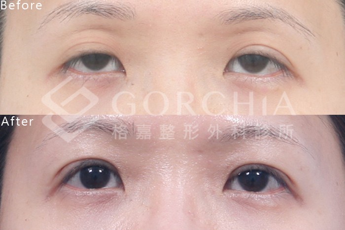 割式提眼肌手術案例-格嘉整形外科診所